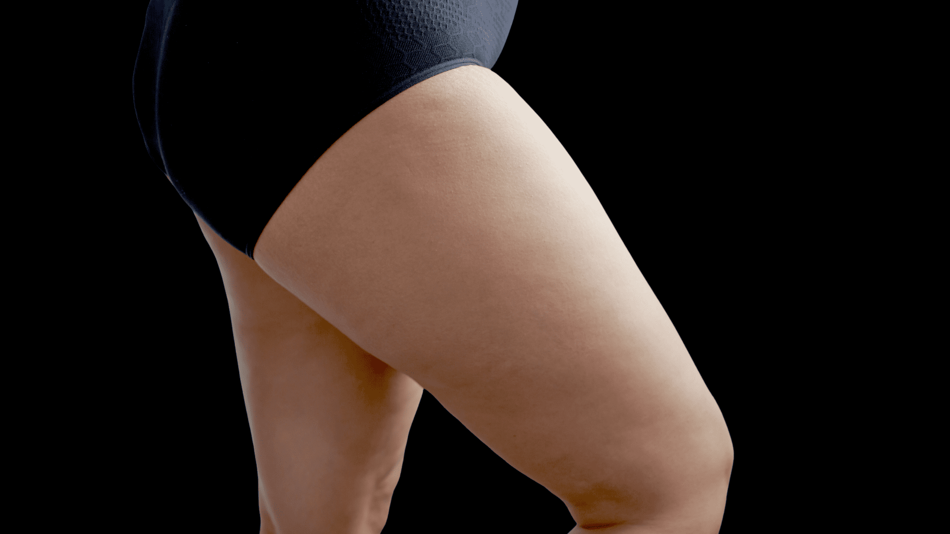 Outcome for Aesthetic Upper Leg Augmentation with Four (4) Thigh